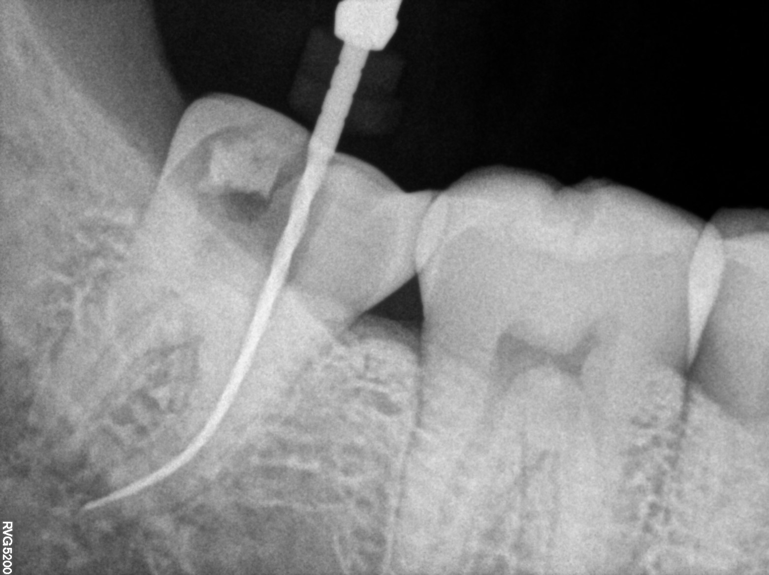 Dental X-ray